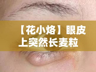 【花小烙】眼皮上为什么会突然长麦粒肿？