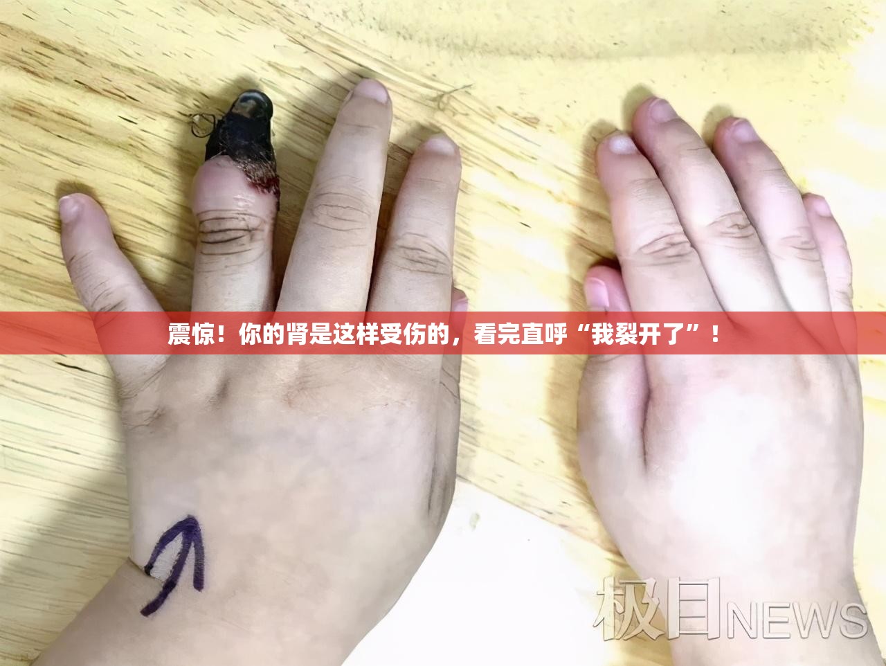 震惊！你的肾是这样受伤的，看完直呼“我裂开了”！